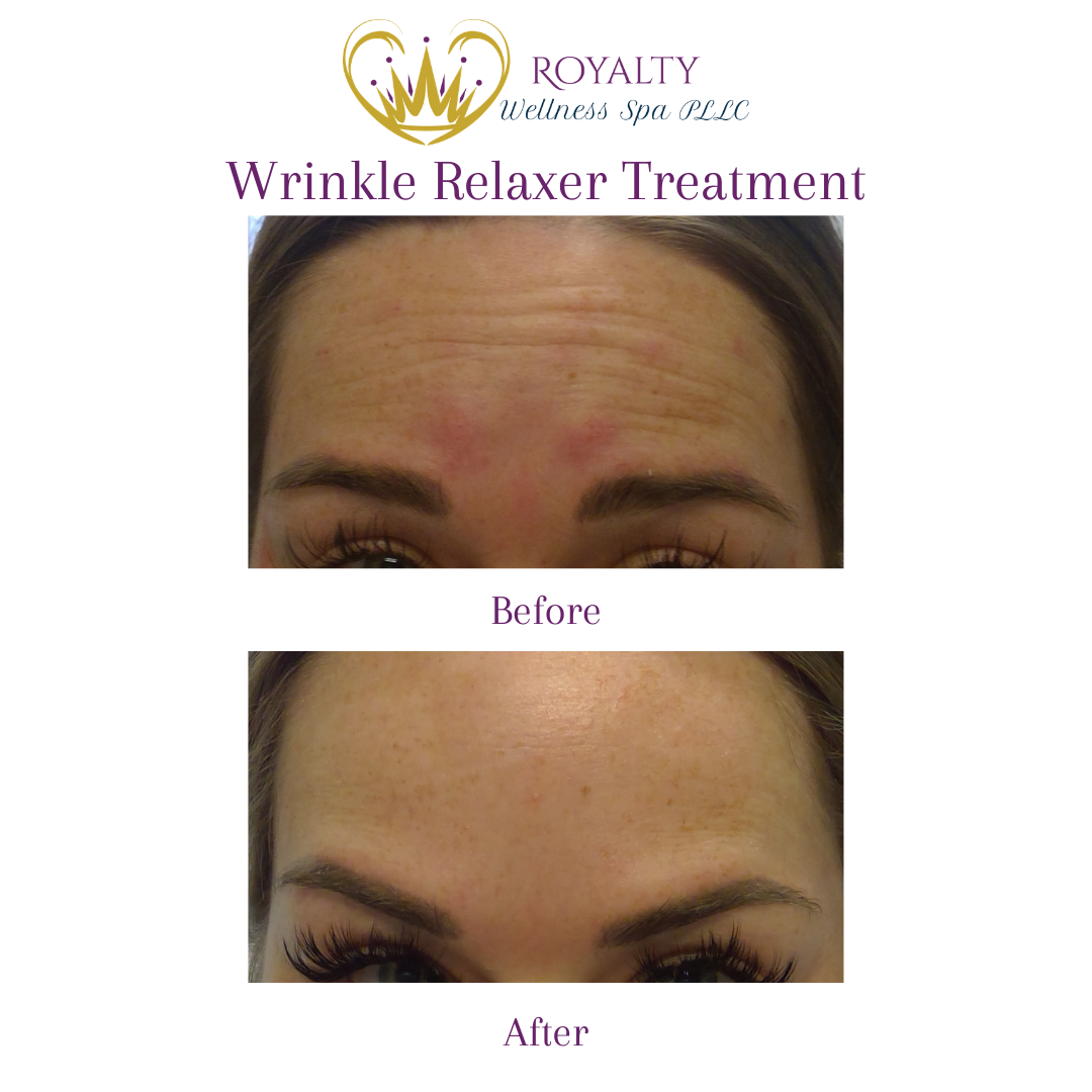Wrinkle Relaxer Treatment | Royalty Wellness Spa | Memphis, TN