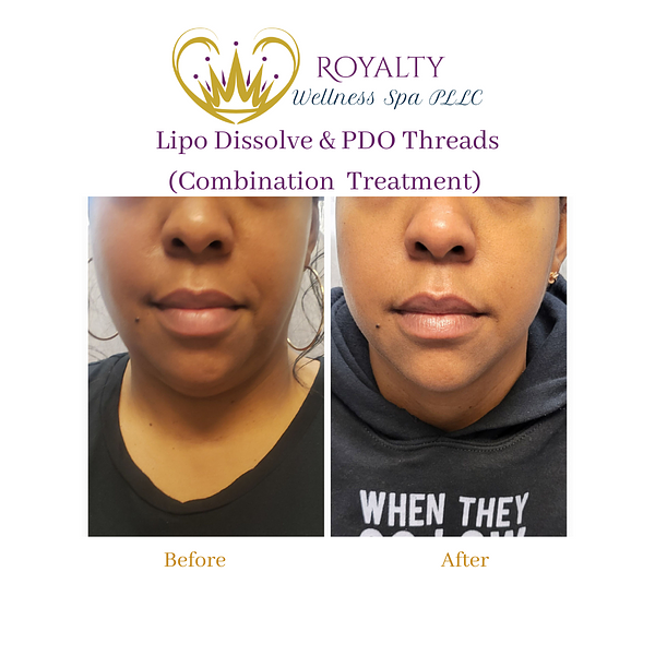 Lipo dissolve and PDO Threads Before and after | Royalty Wellness Spa | Memphis, TN