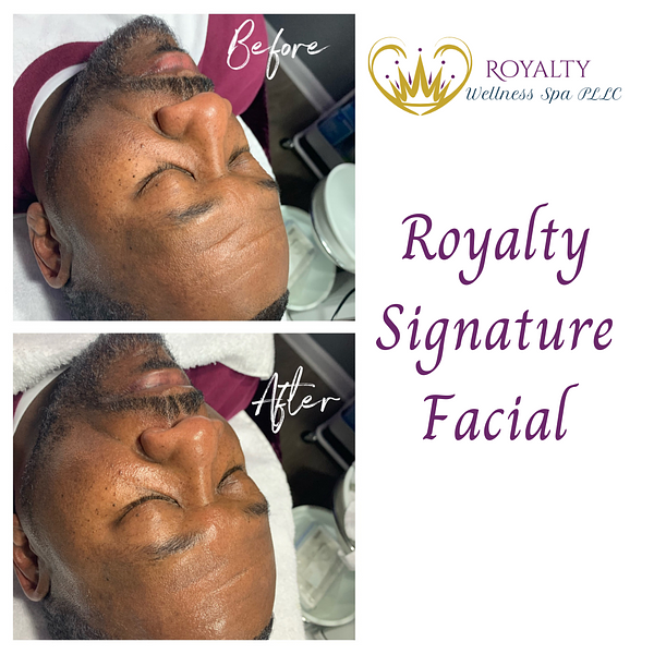 Signature facial before and after | Royalty Wellness Spa | Memphis, TN