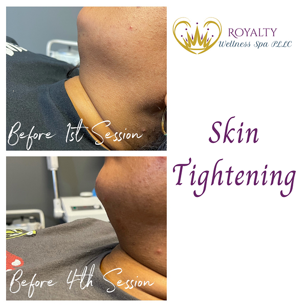 Skin Tightening | Royalty Wellness Spa | Memphis, TN