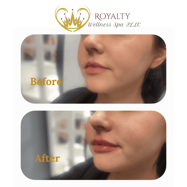 Before And After | Royalty Wellness Spa | Memphis, TN