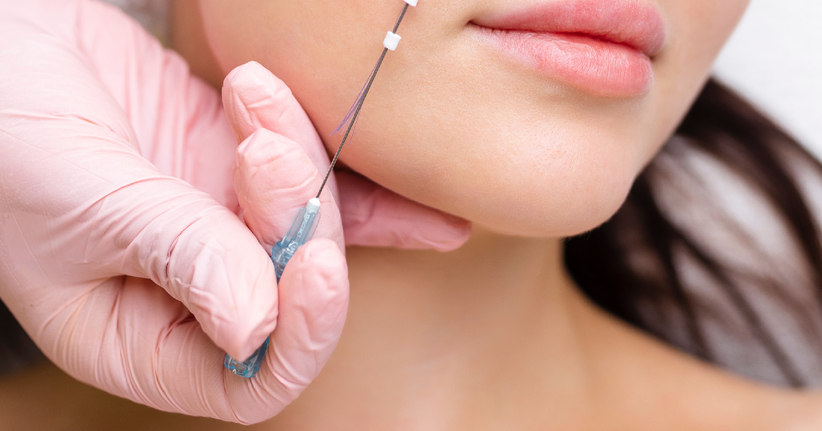 PDO thread lift procedure on a woman's cheek in Memphis, TN
