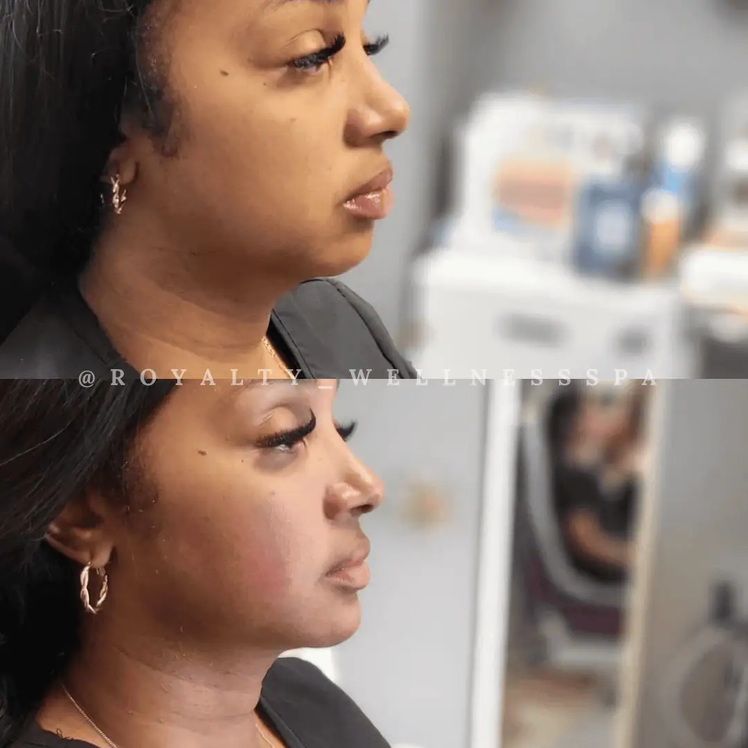 Dermal-Fillers-Before-After-royaltywellnessspa (2)