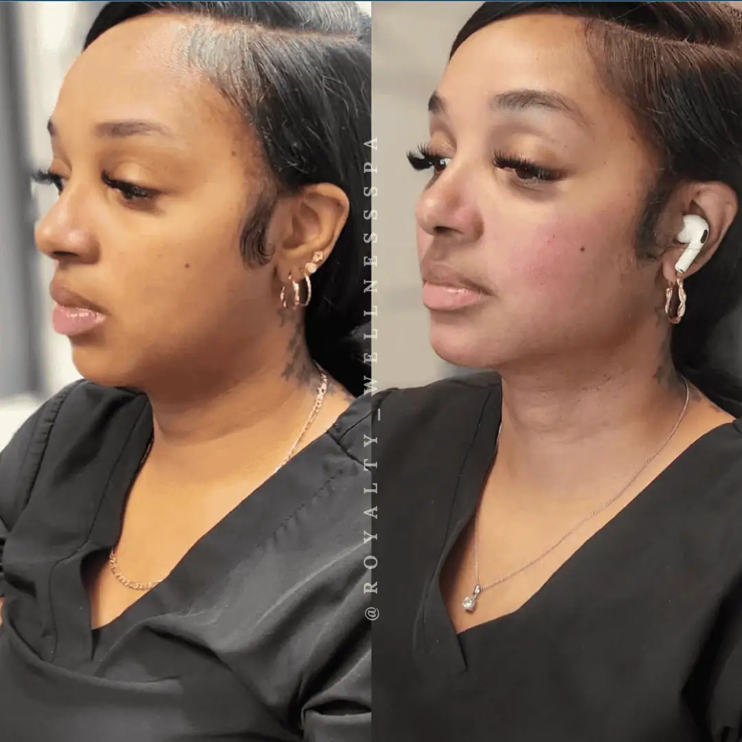 Dermal-Fillers-Before-After-royaltywellnessspa (3)