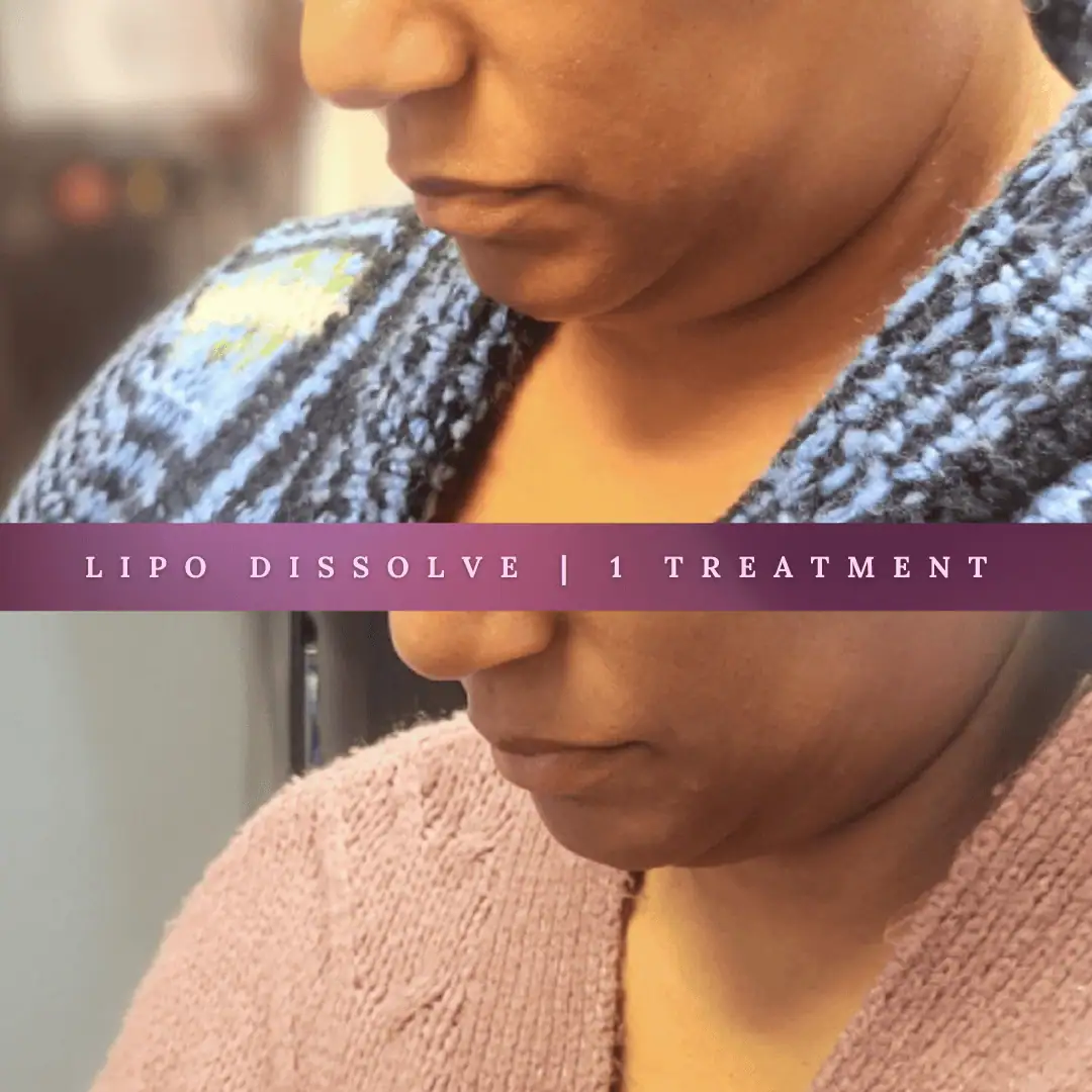 KybellaLipo Dissolve-Before-After