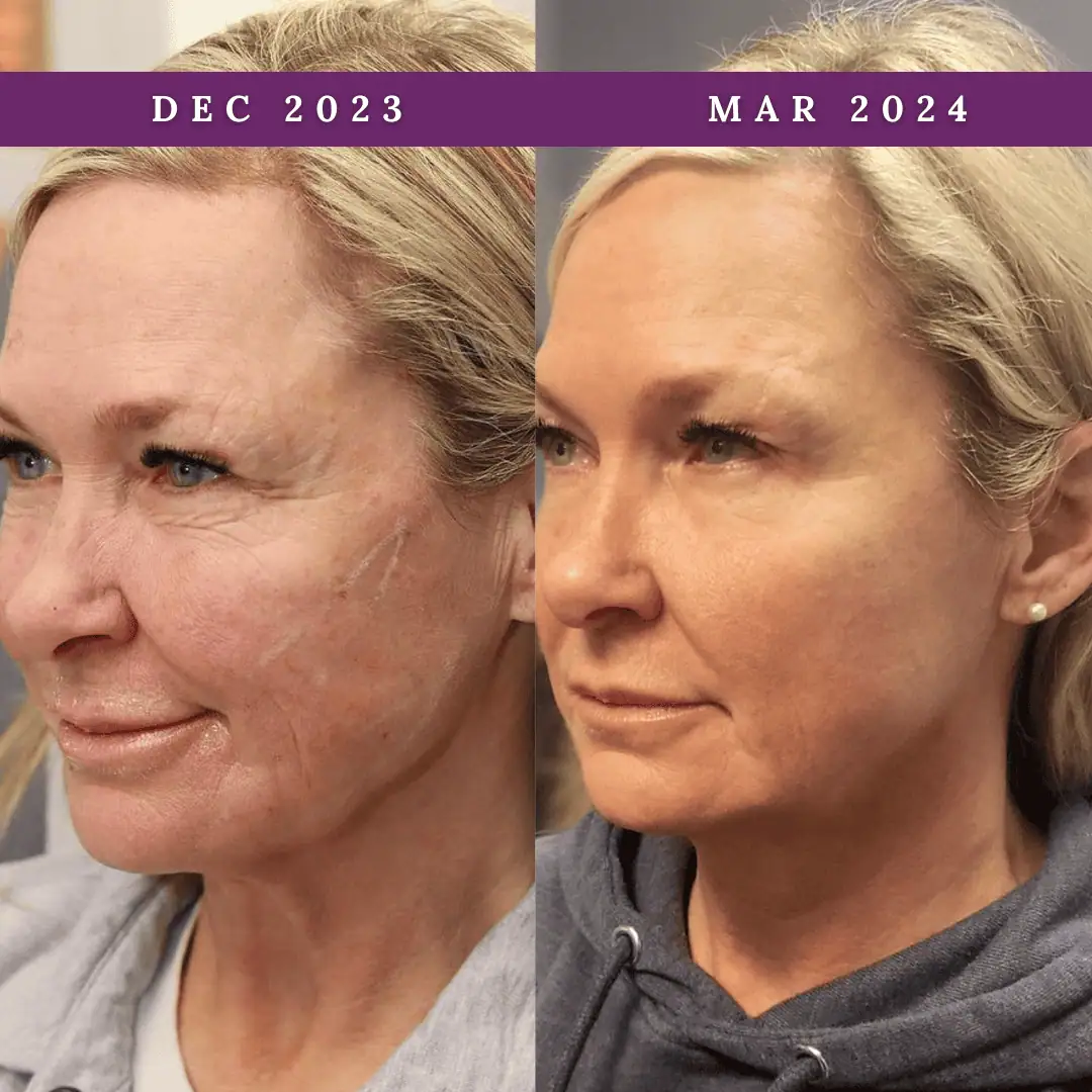 PDO-Threads-Before-After-Royalwellnessspa (1)