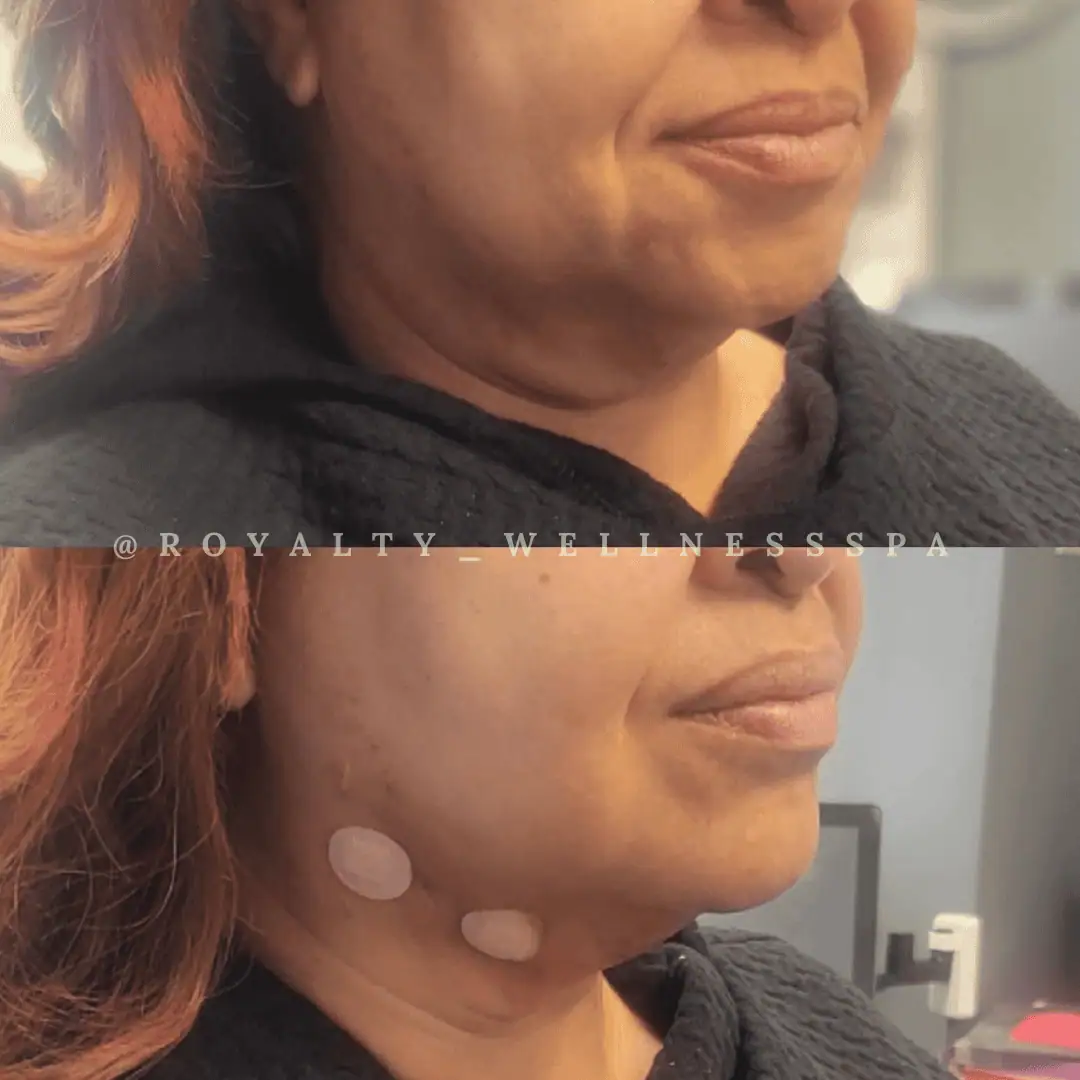 PDO-Threads-Before-After-Royalwellnessspa (3)
