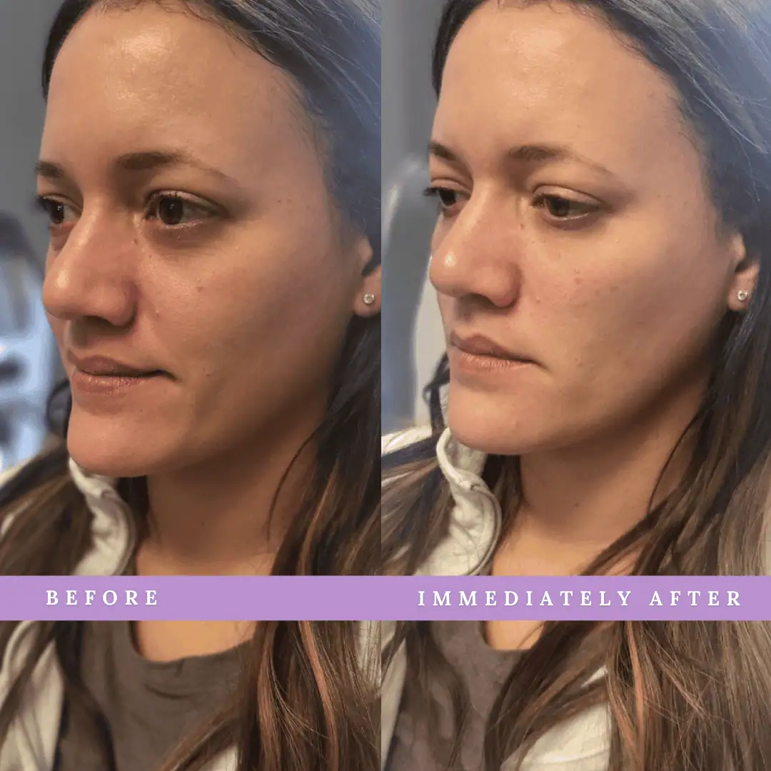 PRP-Before-After-Royalwellnessspa