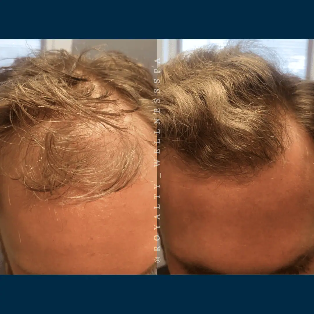 TED Hair Restoration-Before-After