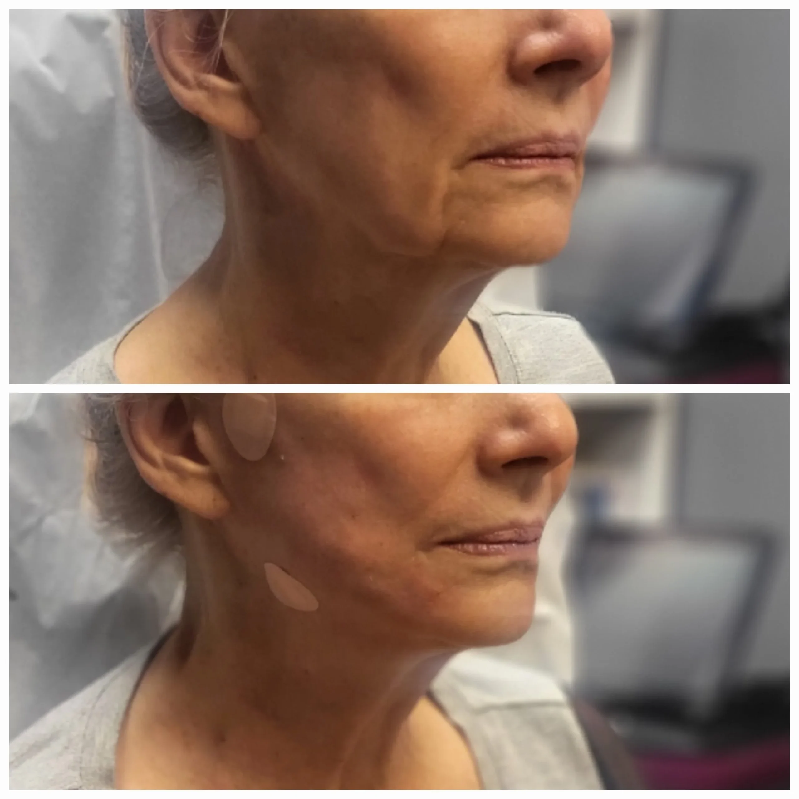 IV Therapy Before and After (1)