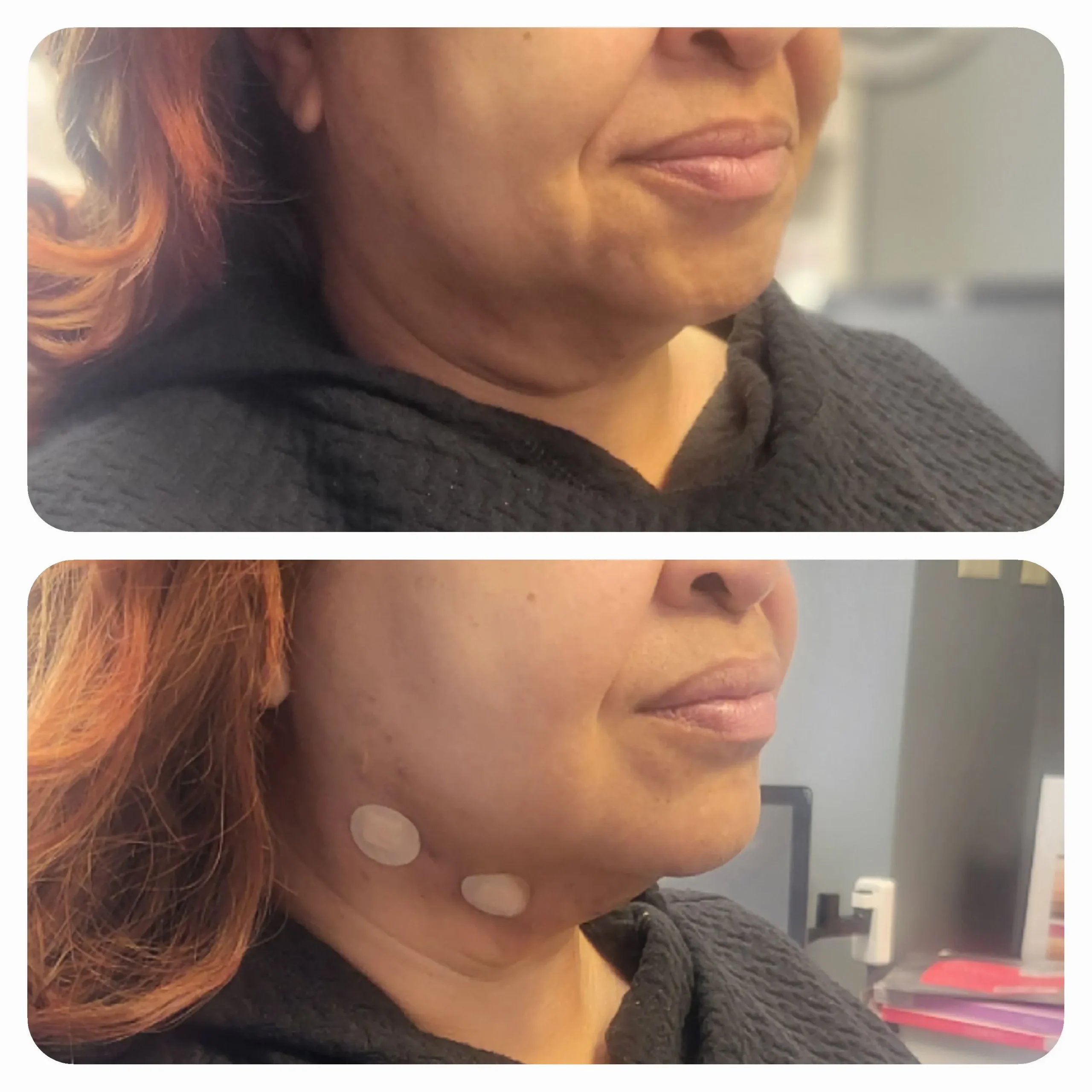 IV Therapy Before and After (2)