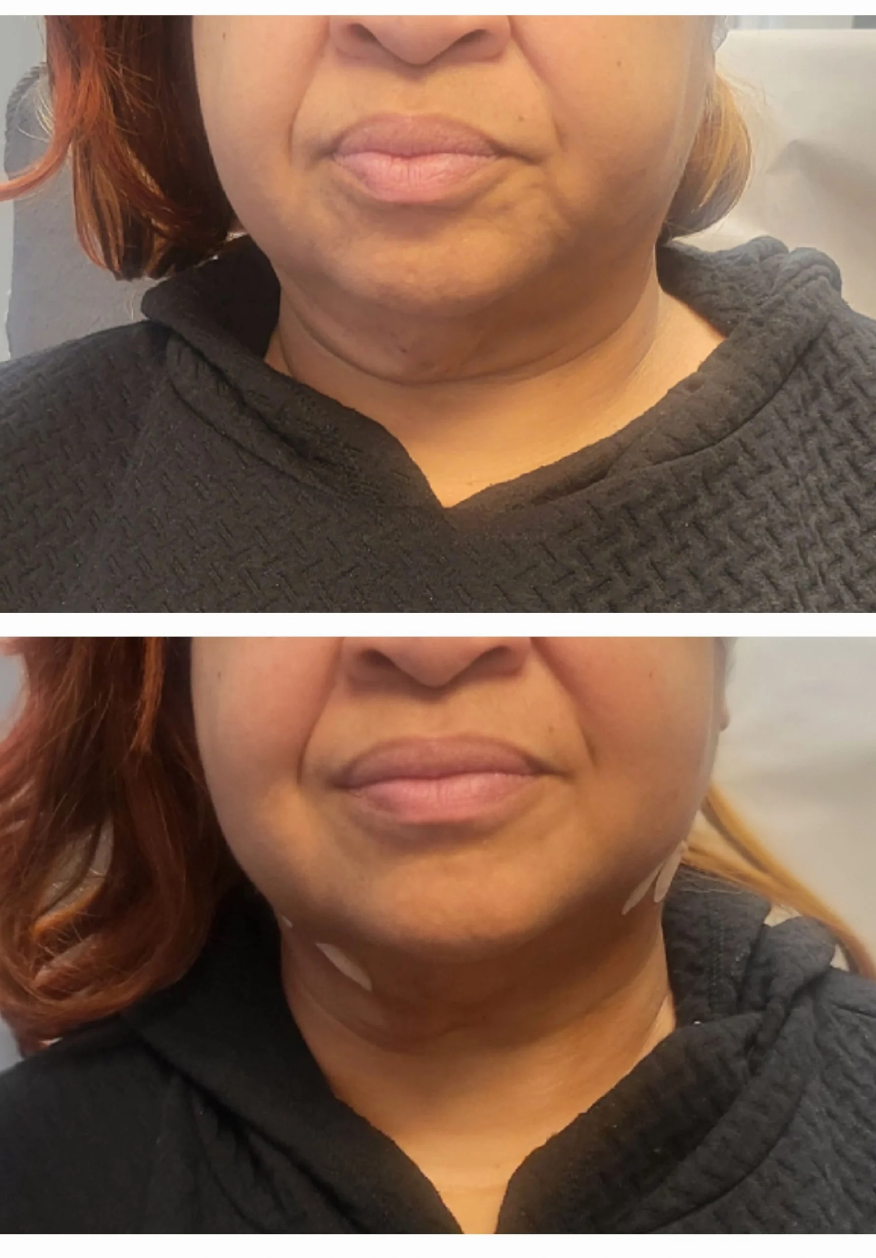 IV Therapy Before and After (3)