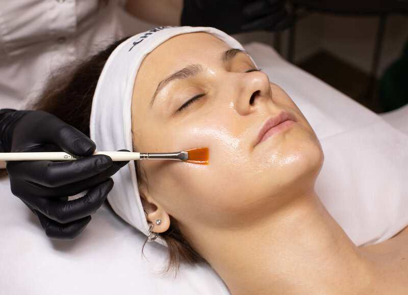 Chemical Peel