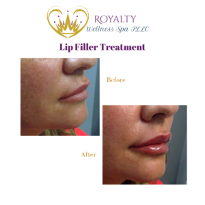 Lip Filler Treatment | Royalty Wellness Spa | Memphis, TN