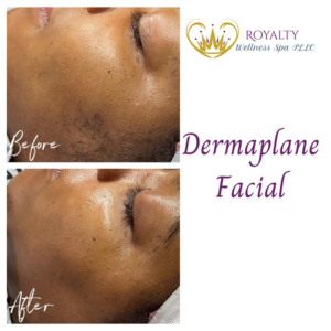 Dermaplane Facial before and after | Royalty Wellness Spa | Memphis, TN