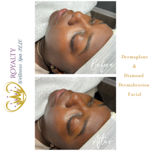 Dermaplane & Diamond Dermabrasion facial Before and after | Royalty Wellness Spa | Memphis, TN