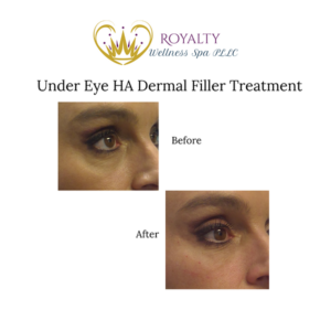 HA Dermal Filler Before and after | Royalty Wellness Spa | Memphis, TN