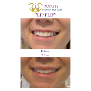 Lip Flip Before and after | Royalty Wellness Spa | Memphis, TN