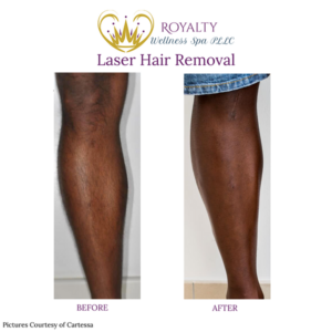 Laser hair removal Before and after | Royalty Wellness Spa | Memphis, TN