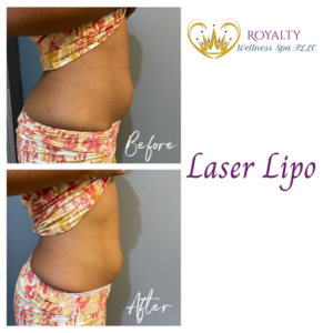 Laser lipo before and after | Royalty Wellness Spa | Memphis, TN