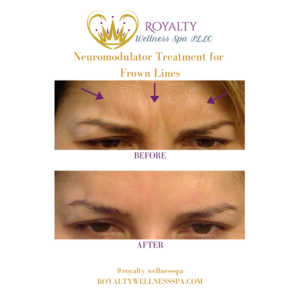 Neuromodulator Before and after | Royalty Wellness Spa | Memphis, TN