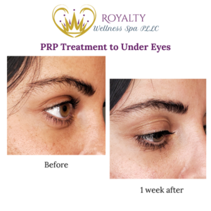 PRP Under eye treatment Before and after | Royalty Wellness Spa | Memphis, TN