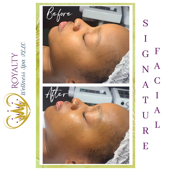 Signature facial Before and after | Royalty Wellness Spa | Memphis, TN