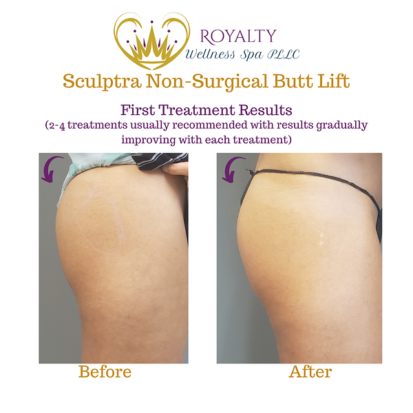 Sculptra Before and after | Royalty Wellness Spa | Memphis, TN