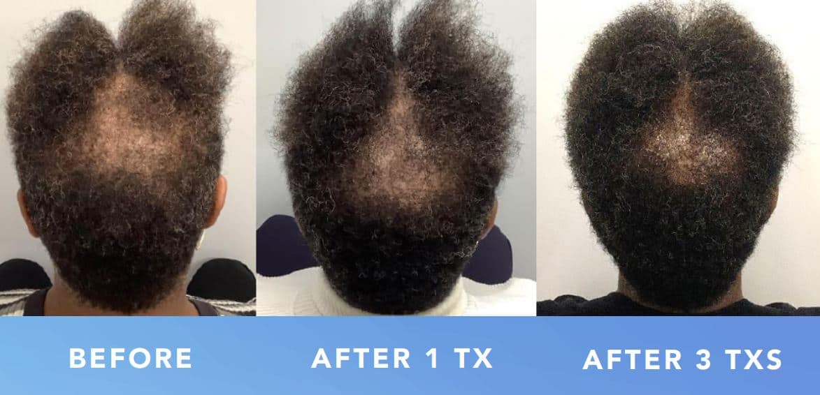 TED Hair Restoration