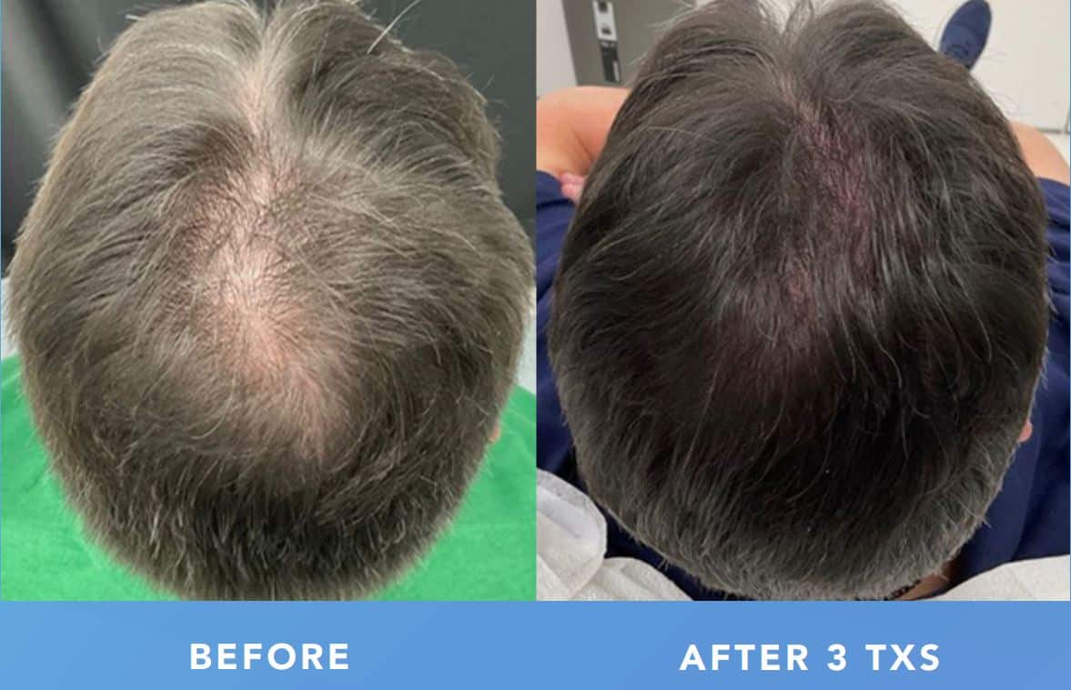 TED Hair Restoration-royaltywellnessspa