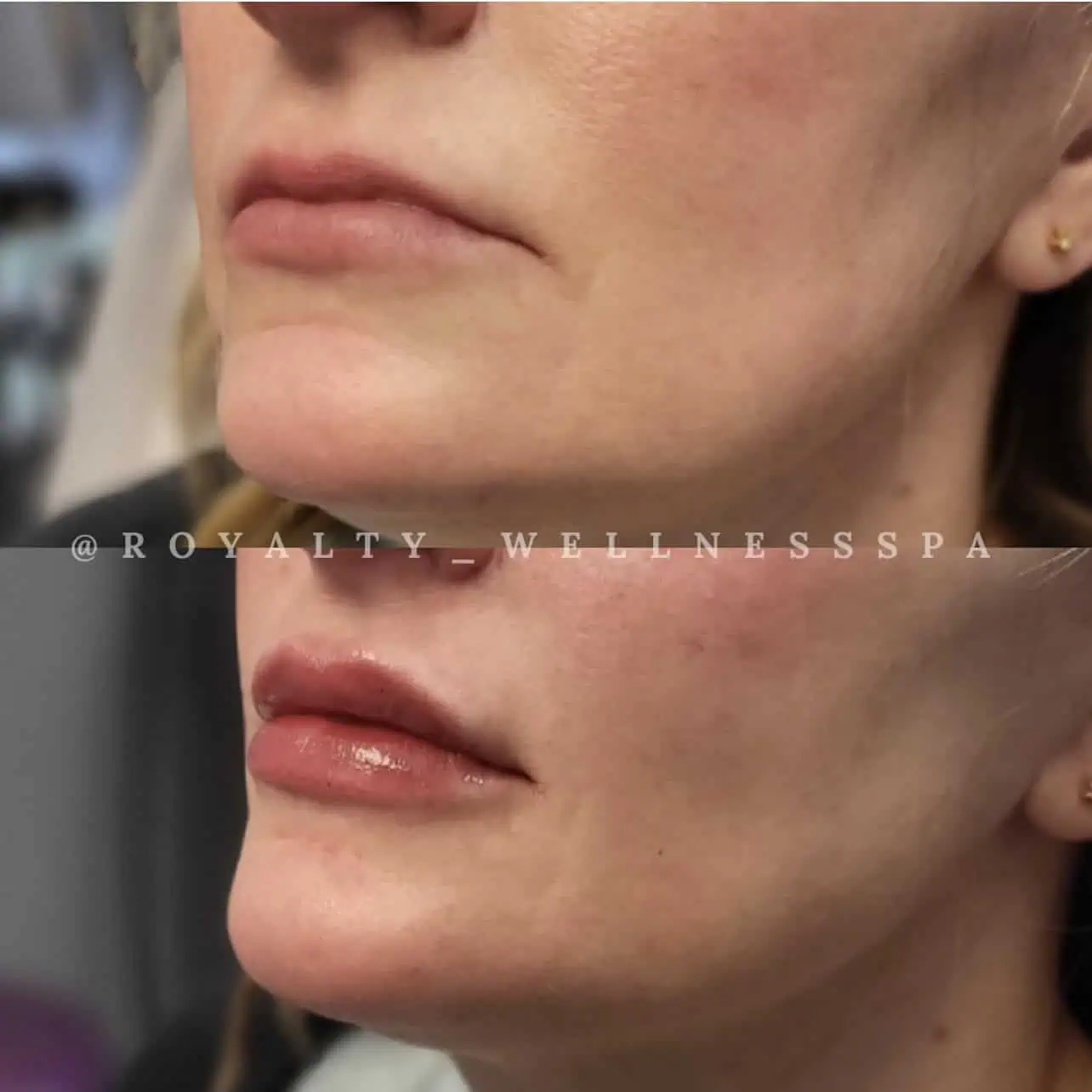 Dermal-Fillers-Before-After-royaltywellnessspa (4)