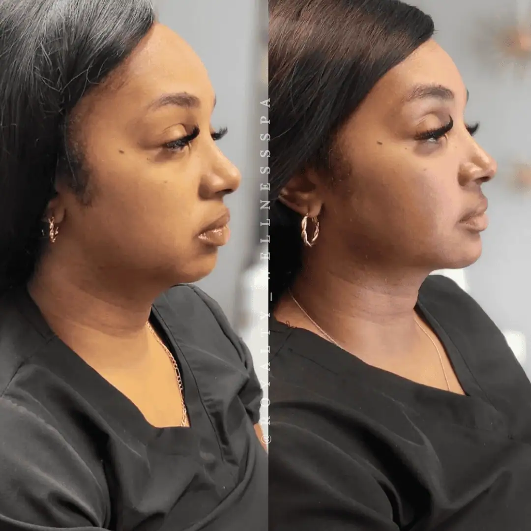 Dermal-Fillers-Before-After-royaltywellnessspa