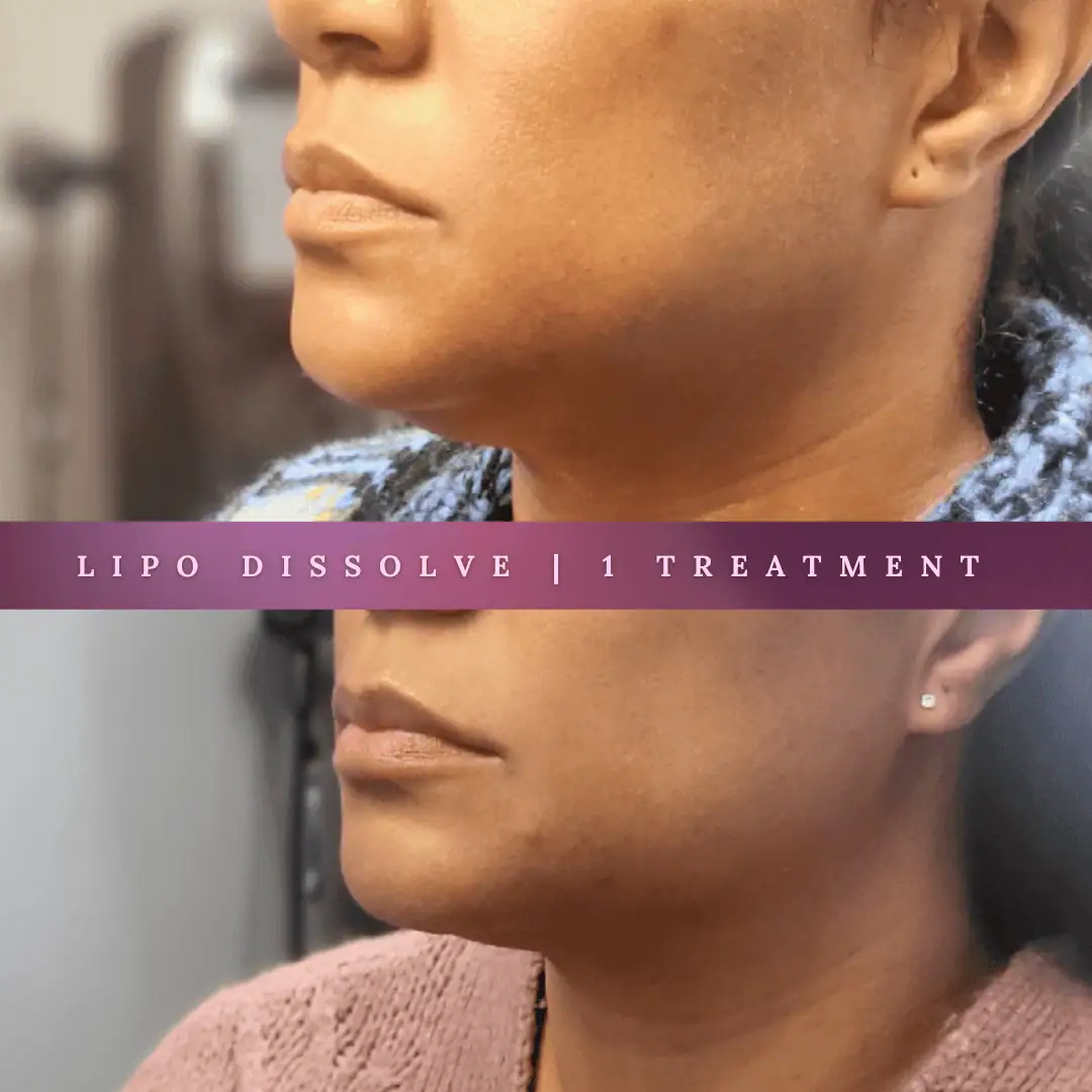 KybellaLipo Dissolve-Before-After-Royal
