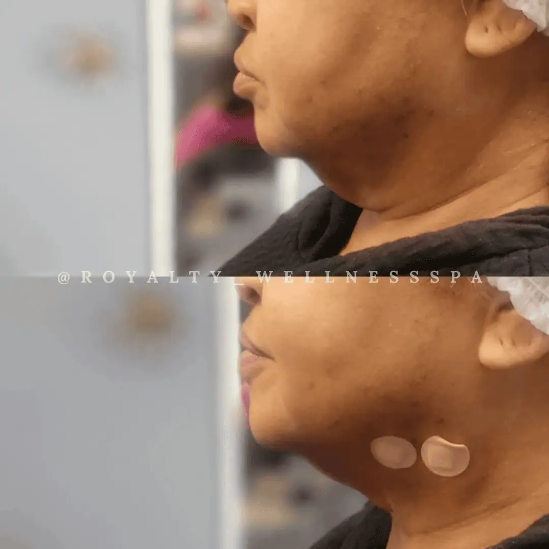 PDO-Threads-Before-After-Royalwellnessspa (2)