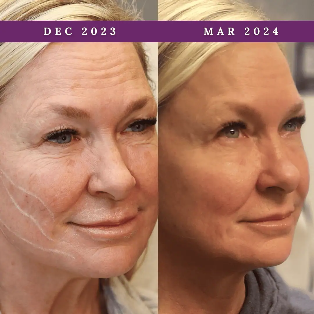 PDO-Threads-Before-After-Royalwellnessspa (4)