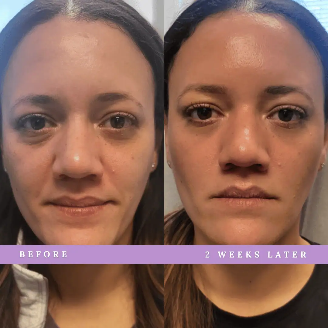 PRP-Before-After-Royalwellnessspa (2)