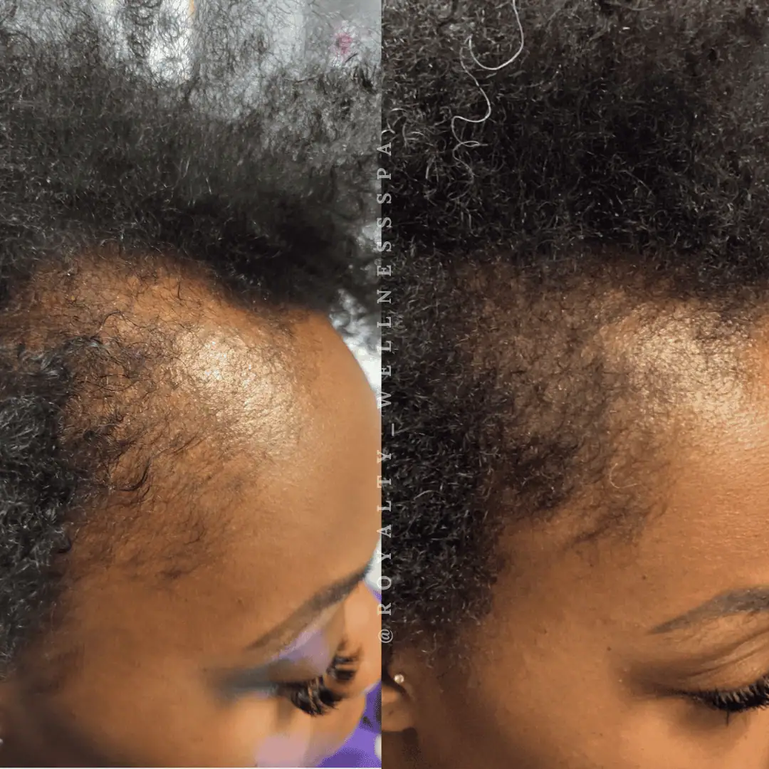 TED Hair Restoration-Before-After (2)